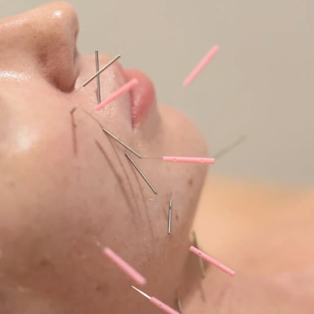 Internal + External Acne Correction at The Dermal Formula in San Mateo, CA